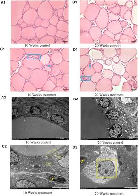 A new LNC89/LNC60-Col11a2 axis revealed by whole-transcriptome analysis may be associated with goiters related to excess iodine nutrition